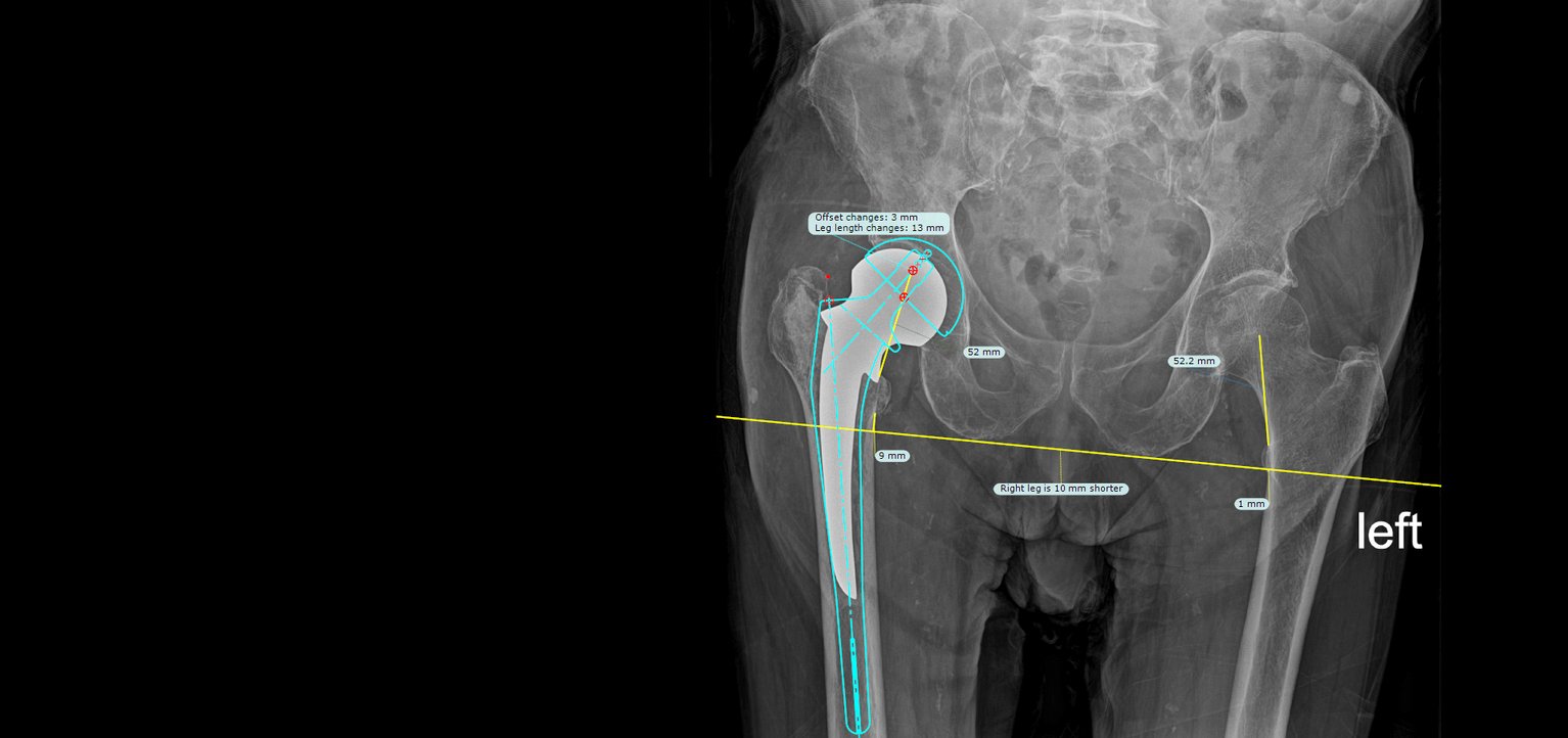 Hip Revision Surgery – From Fracture to Success