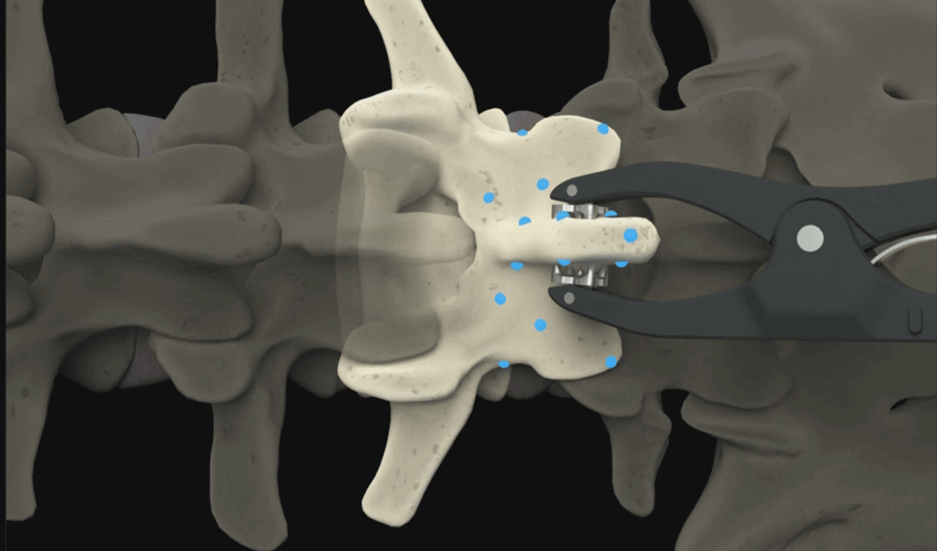 A Step-by-Step Guide to Image Registration for Spine Surgery
