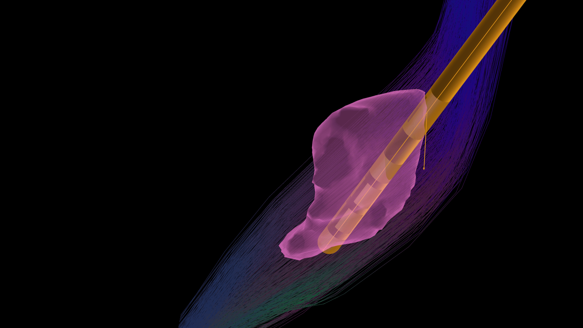 Teaser image: functional neurosurgery planning solutions