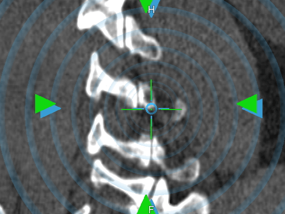 Screenshot of the Brainlab Spine Navigation Software showcasing the instrument tip offset tool for degenerative cases