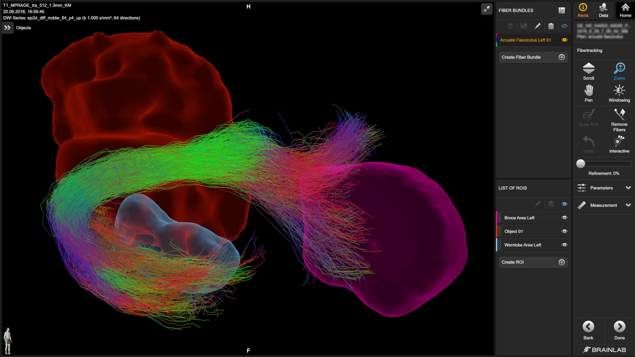 Brain tractography showing detailed neural pathways and tumor visualization.