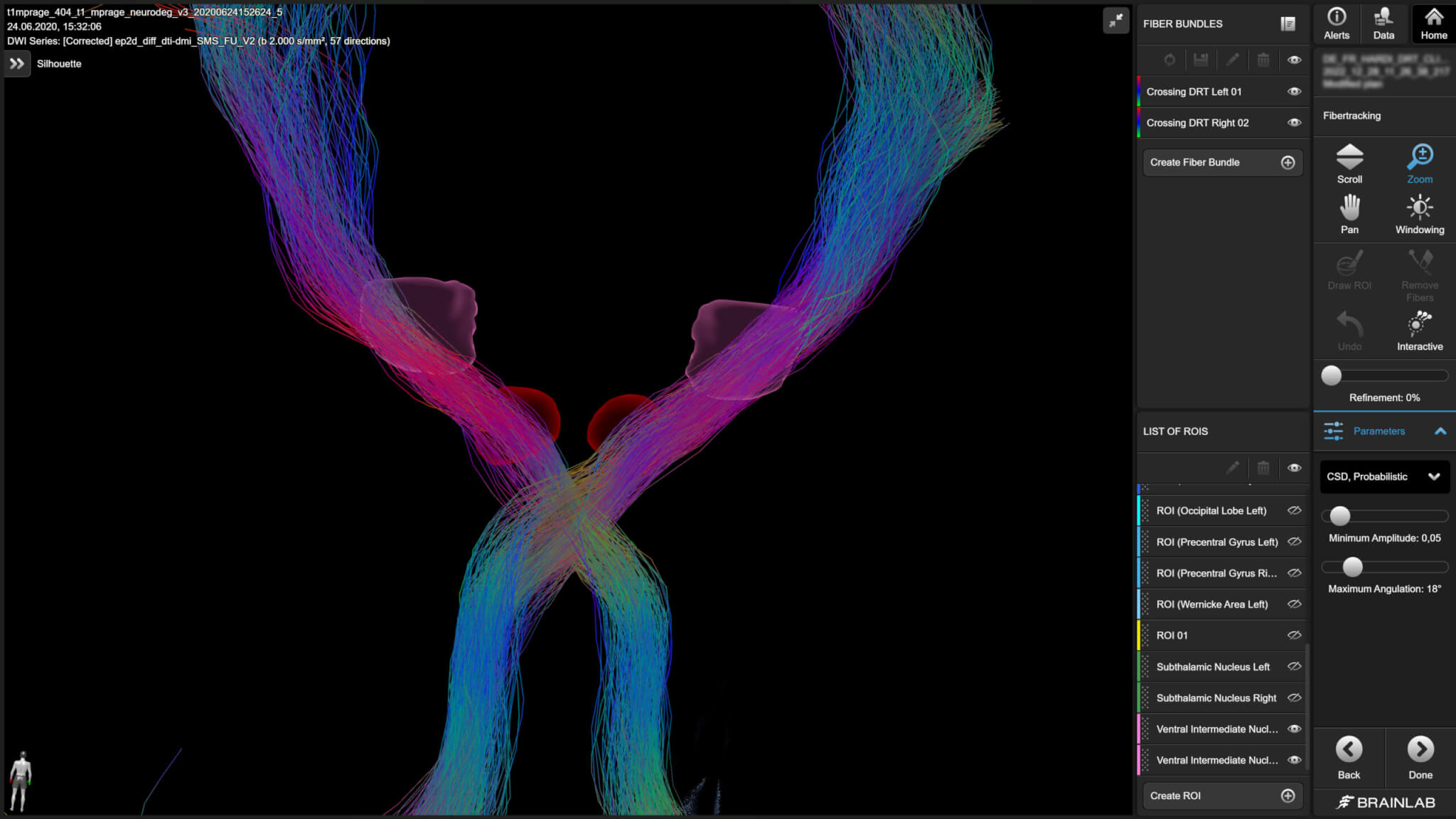 Visualization of complex brain fiber pathways using CSD-based tractography