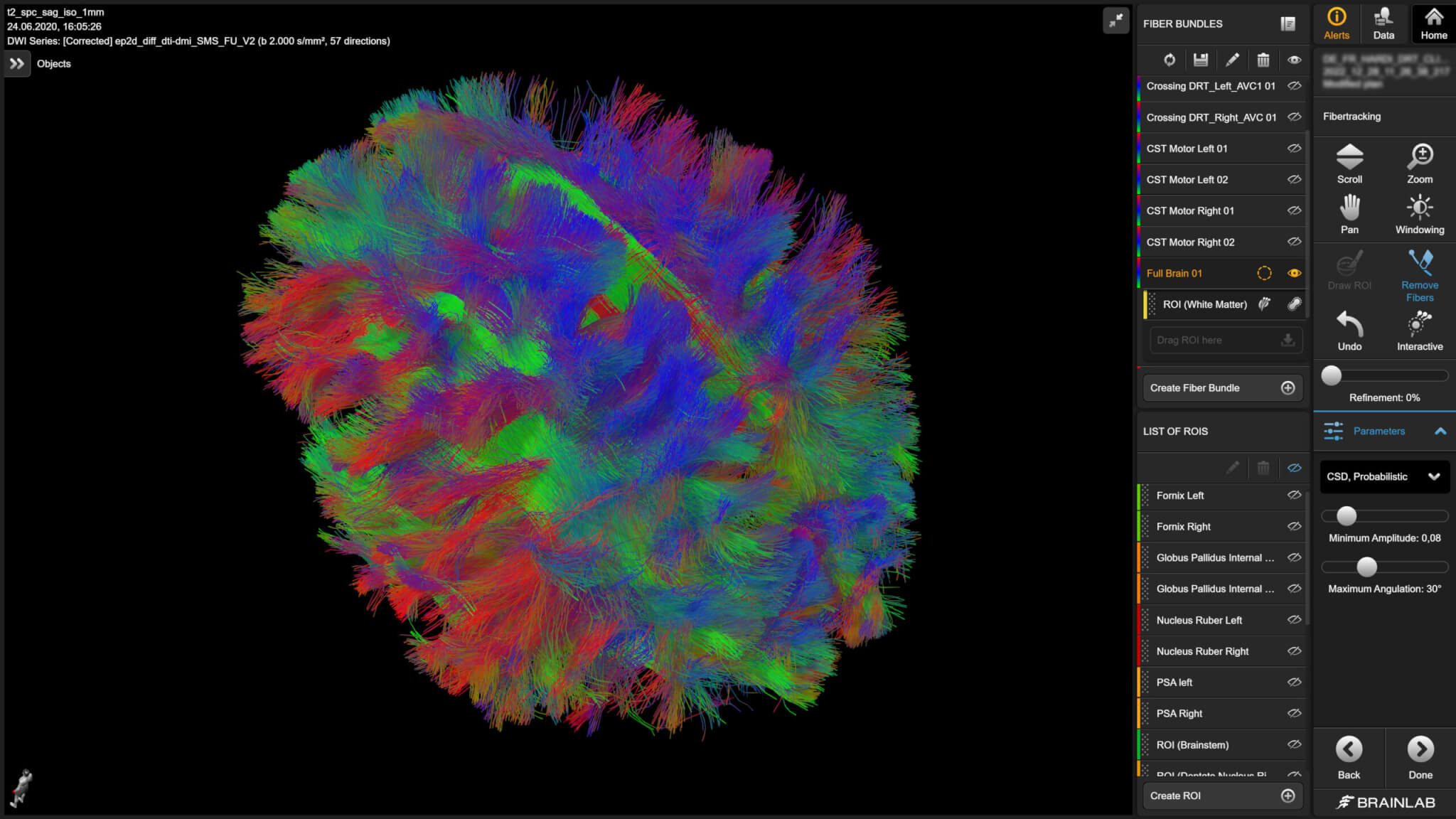 High-resolution probabilistic tractography image showing intricate neural pathways - Fibertracking