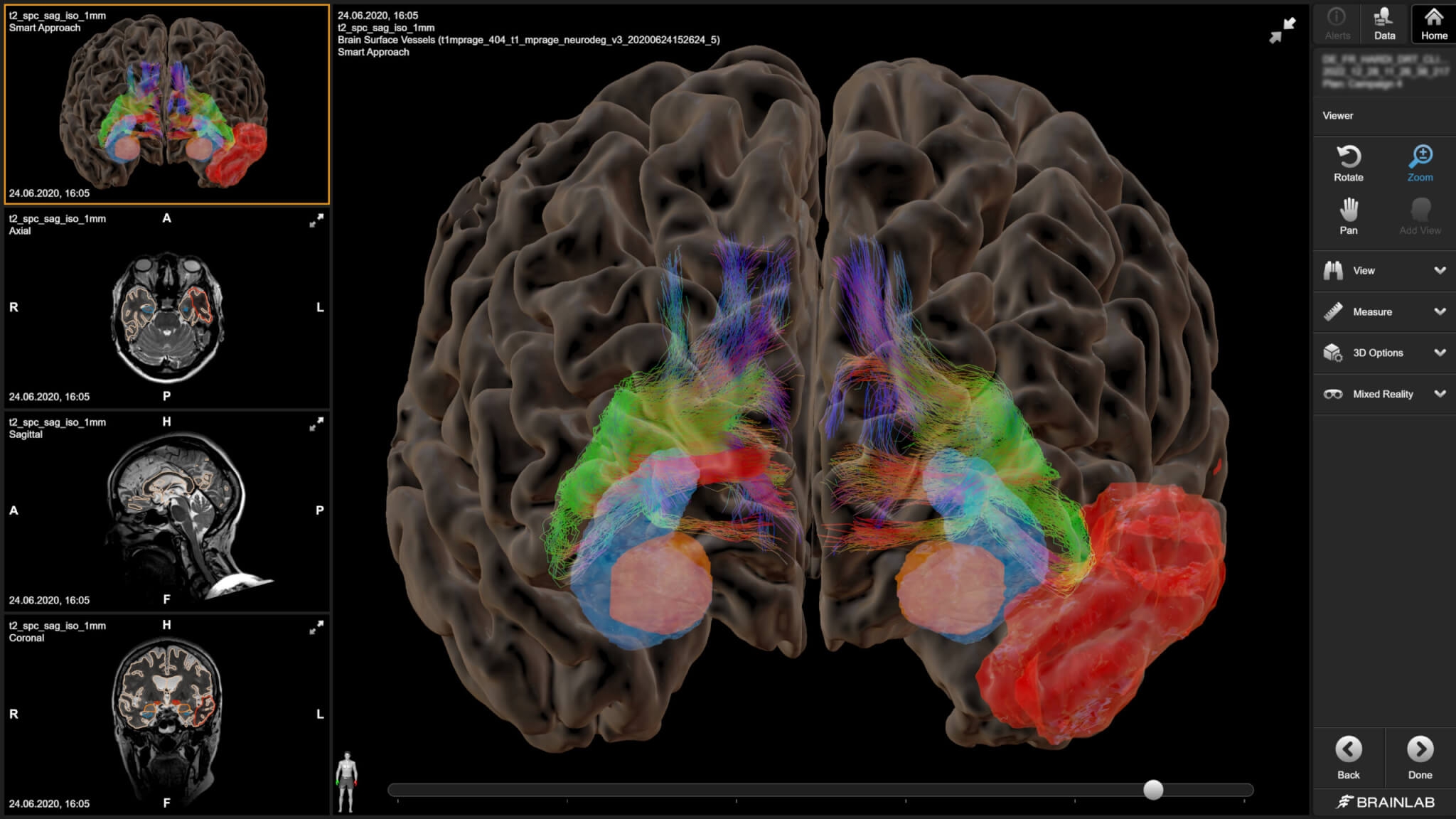 3D brain visualization highlighting neural pathways for epilepsy surgery planning.