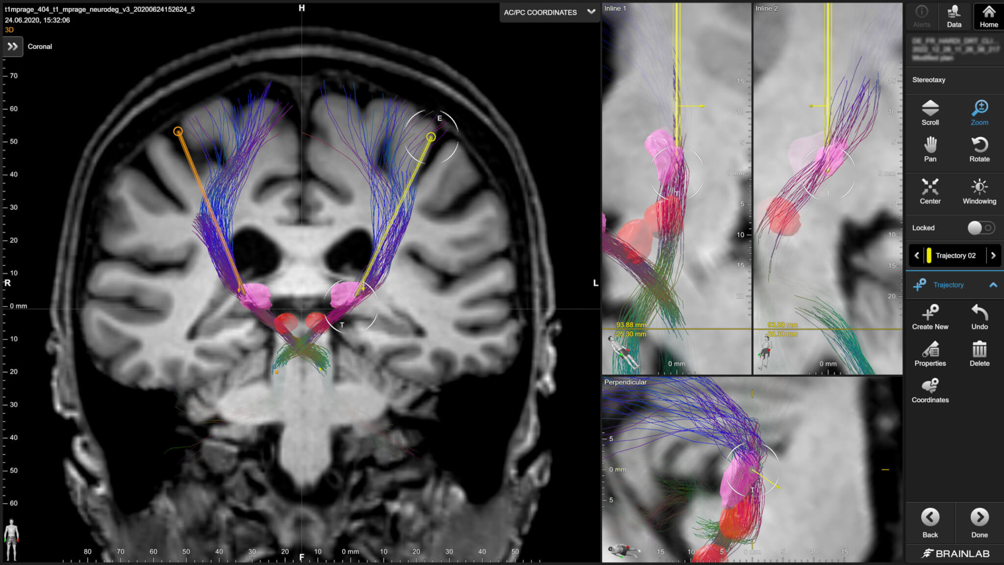 Brain imaging showing DBS targeting with fiber tracking for precise stimulation.