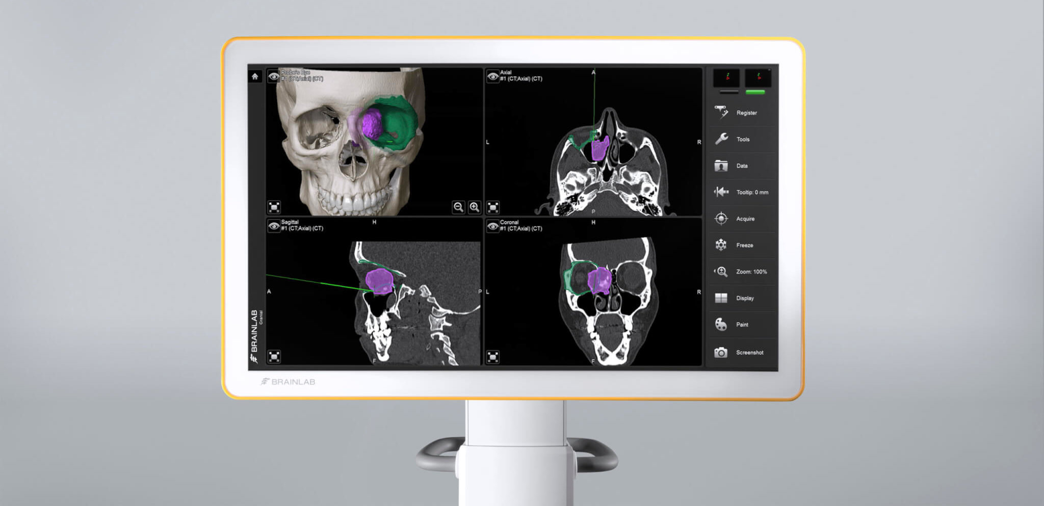 2.tumor-resection-cases-scaled-e1618848397378_webinars.jpg