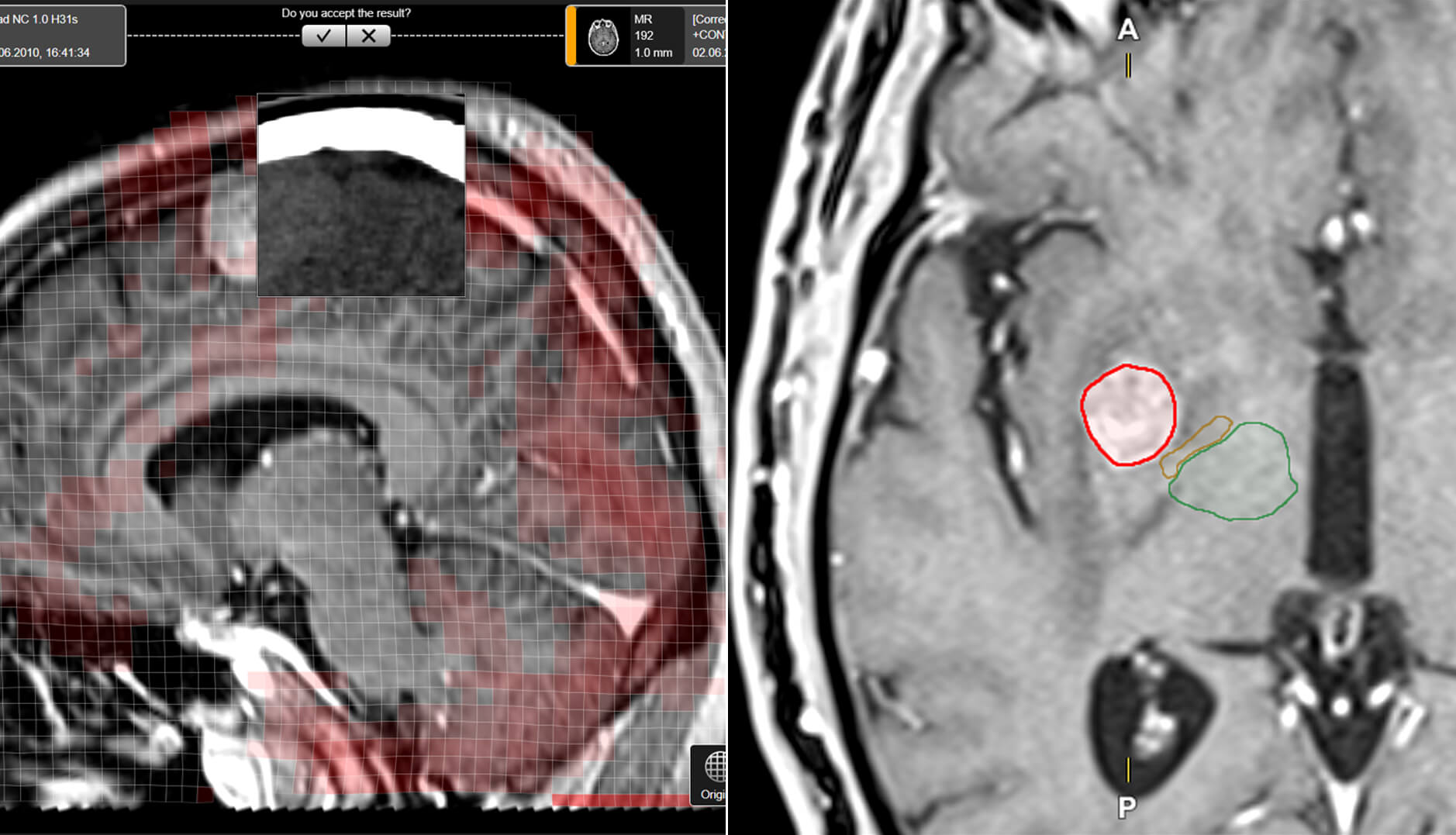Screenshot: Enhanced Target Definition in Radiosurgery with Elements
