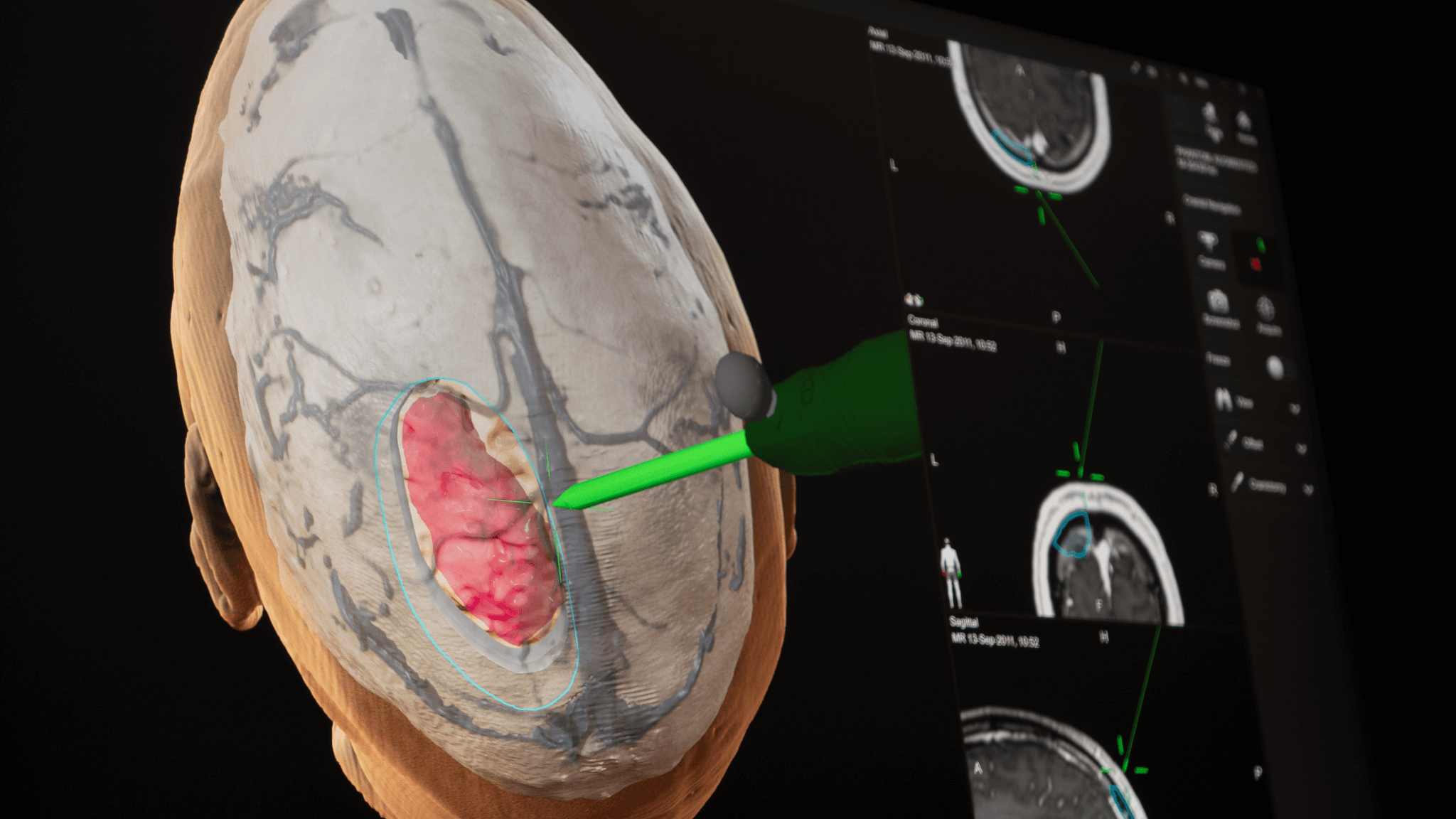 Screenshot: Cranial Navigation - Virtual scalpel simulating craniotomy