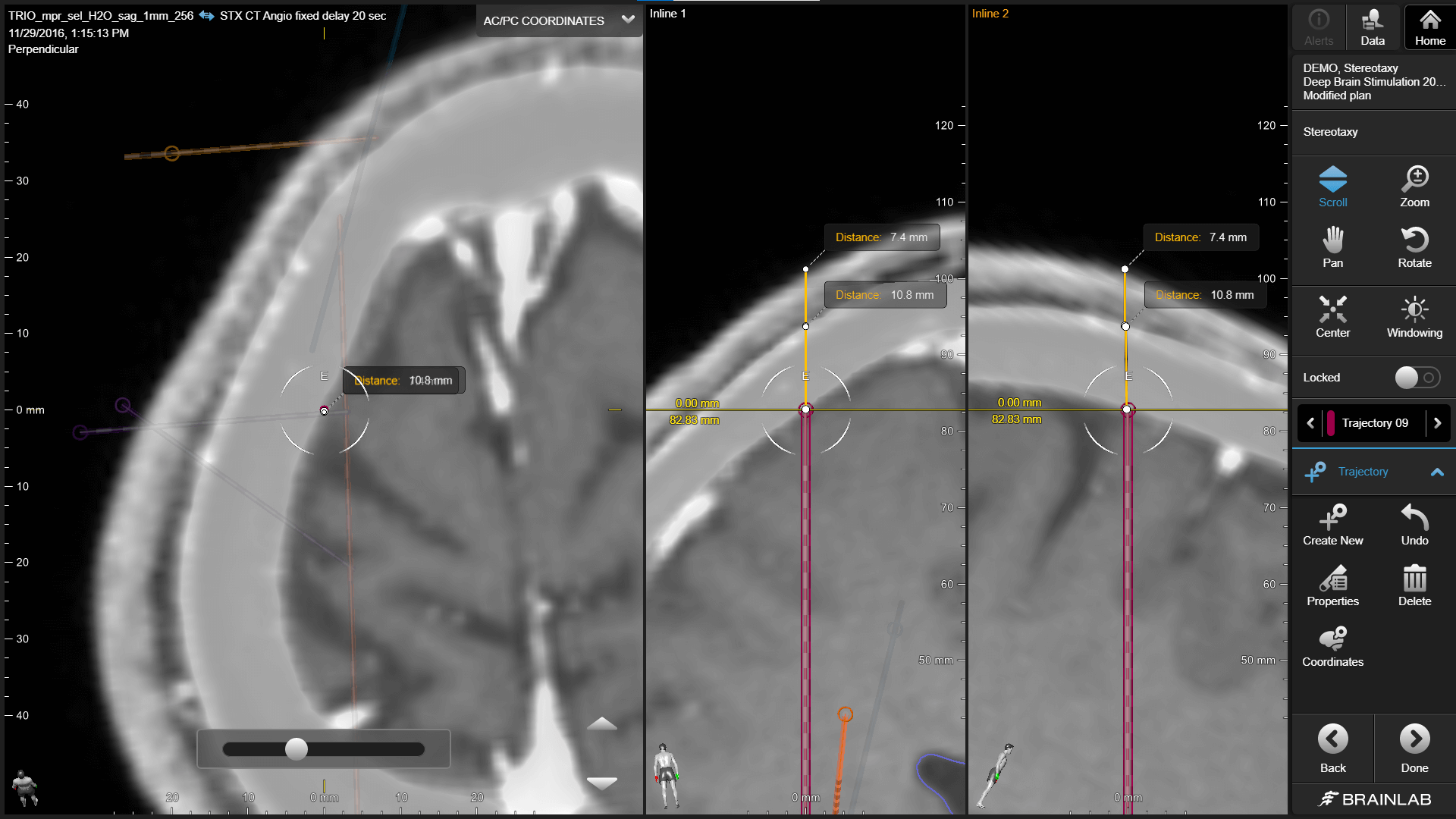 Screenshot of the Alignment Software Cranial depicting an sEEG procedure with Cirq robotic assistance