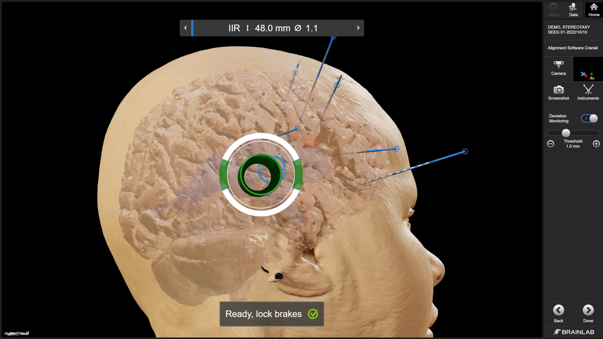 Screenshot of the Cirq Robotic Alignment Module assisting with alignment and placement of sEEG electrodes