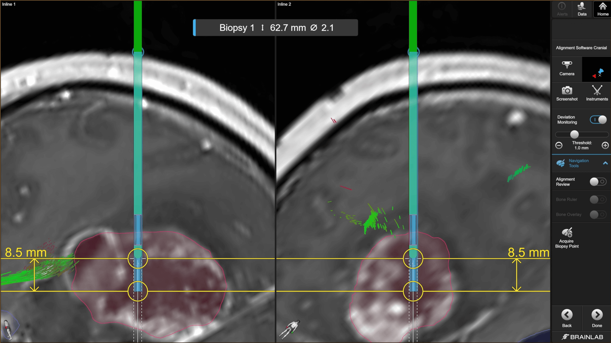 Screenshot: Real-time tracking of the Biopsy Needle using Brainlab navigation software and Cirq