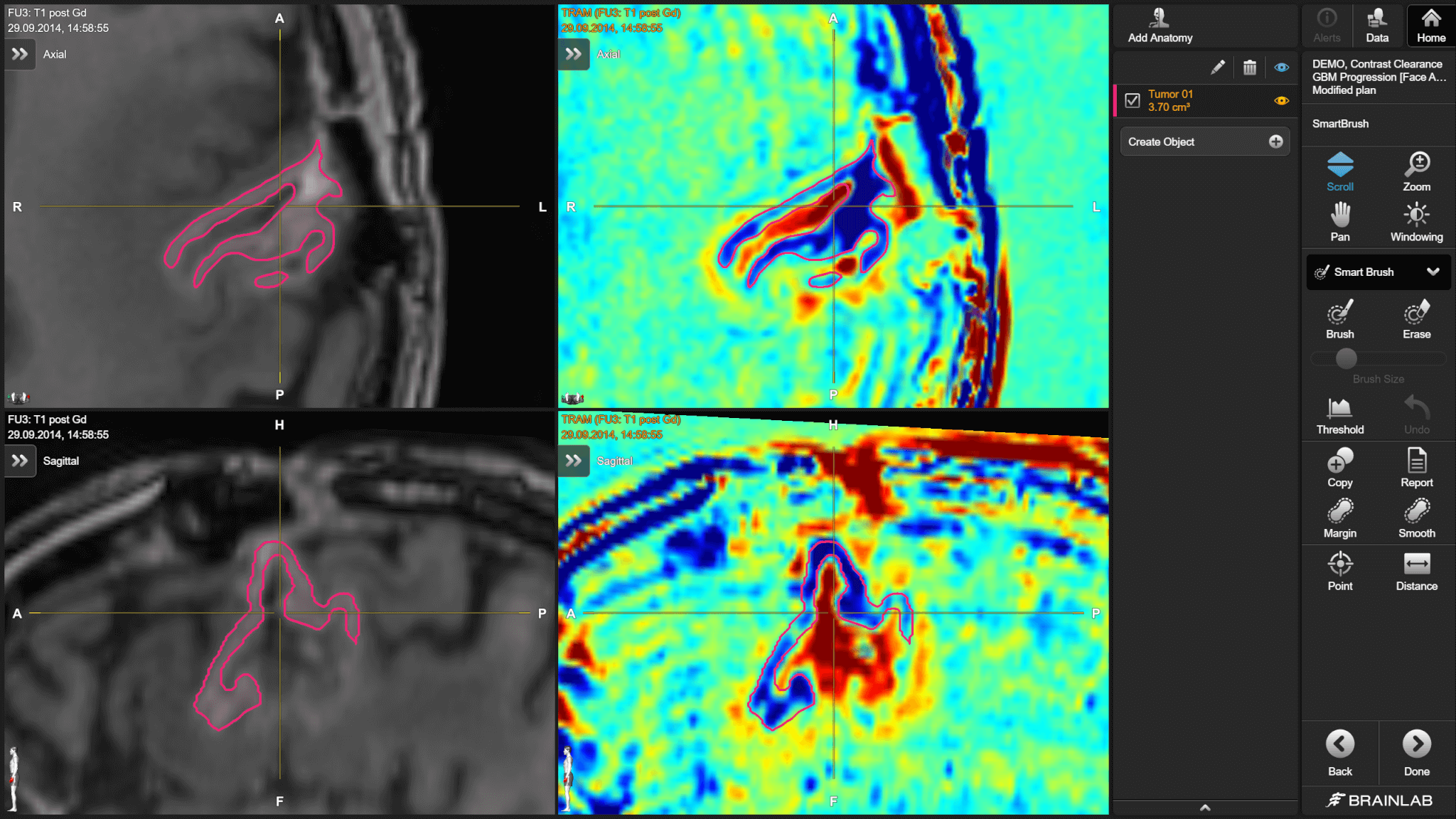 Screenshot: Methodology for Contrast Clearance Analysis from Dual MRI Series