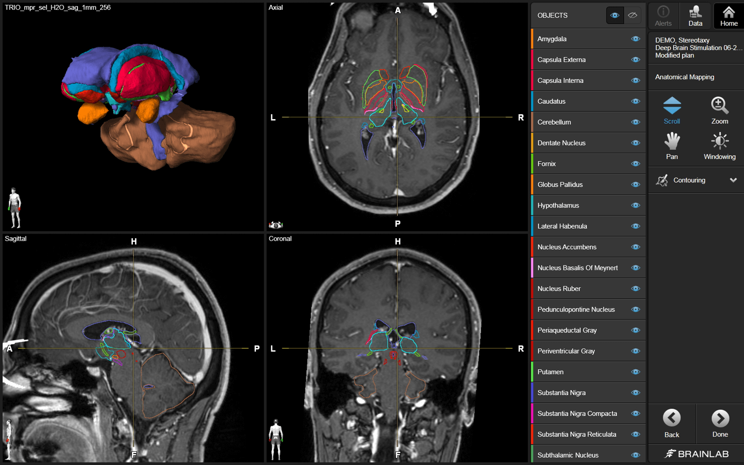 Screenshot of the Cranial functional workflow in Elements: 3D outlining of Basal Ganglia Region