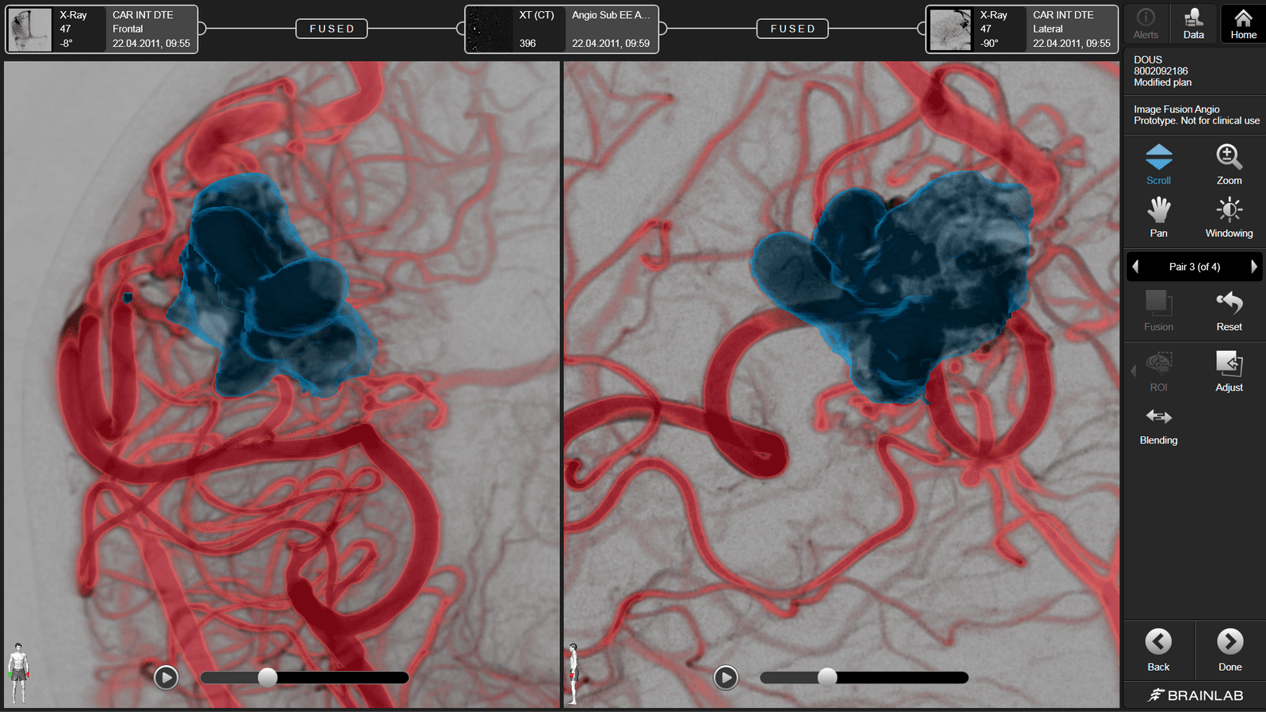 Screenshot: Diagnostic angiography data usage with Elements