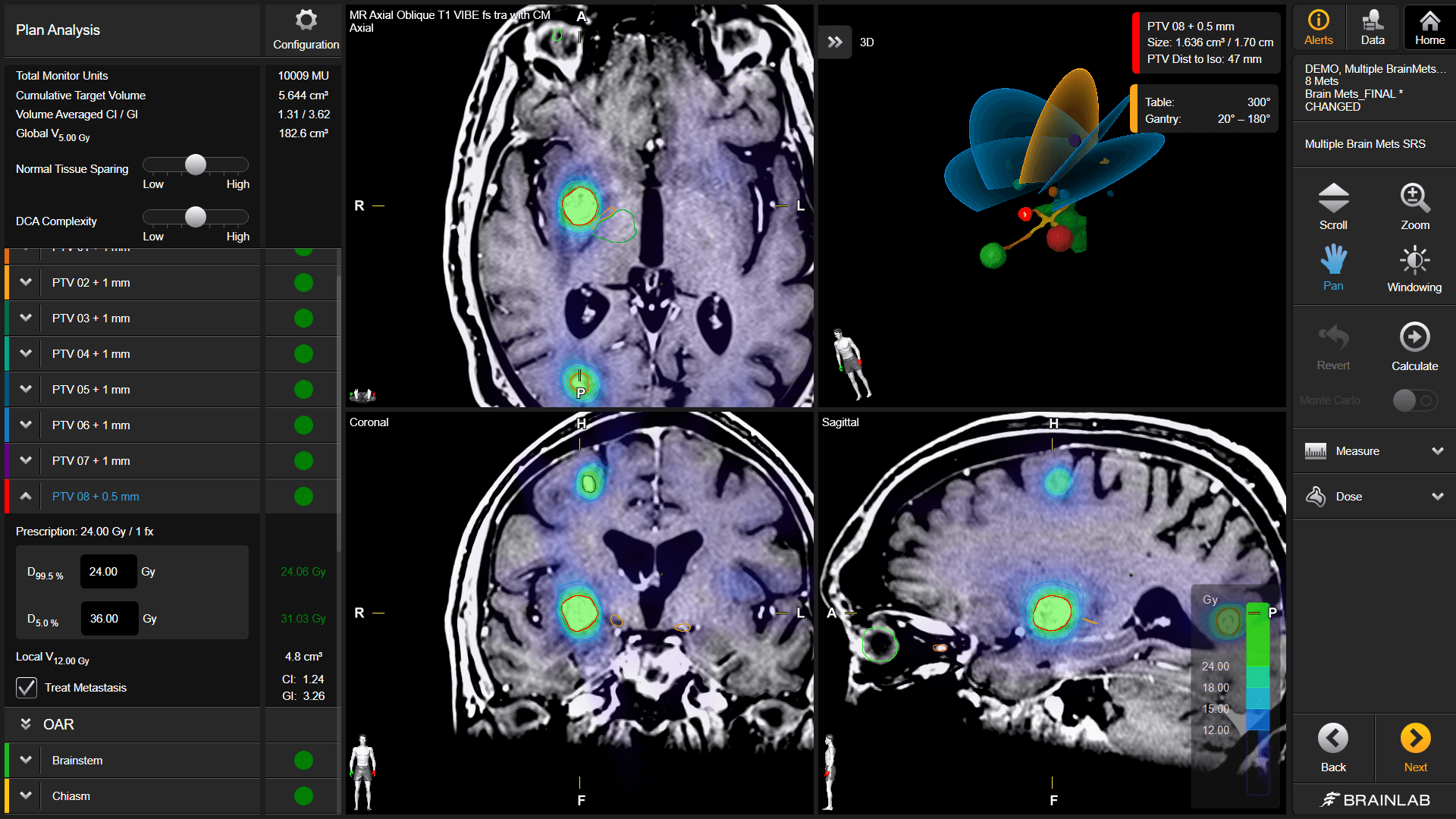 Screenshot: Elements Multiple Brain Mets SRS - Inverse optimized dynamic conformal arc treatment