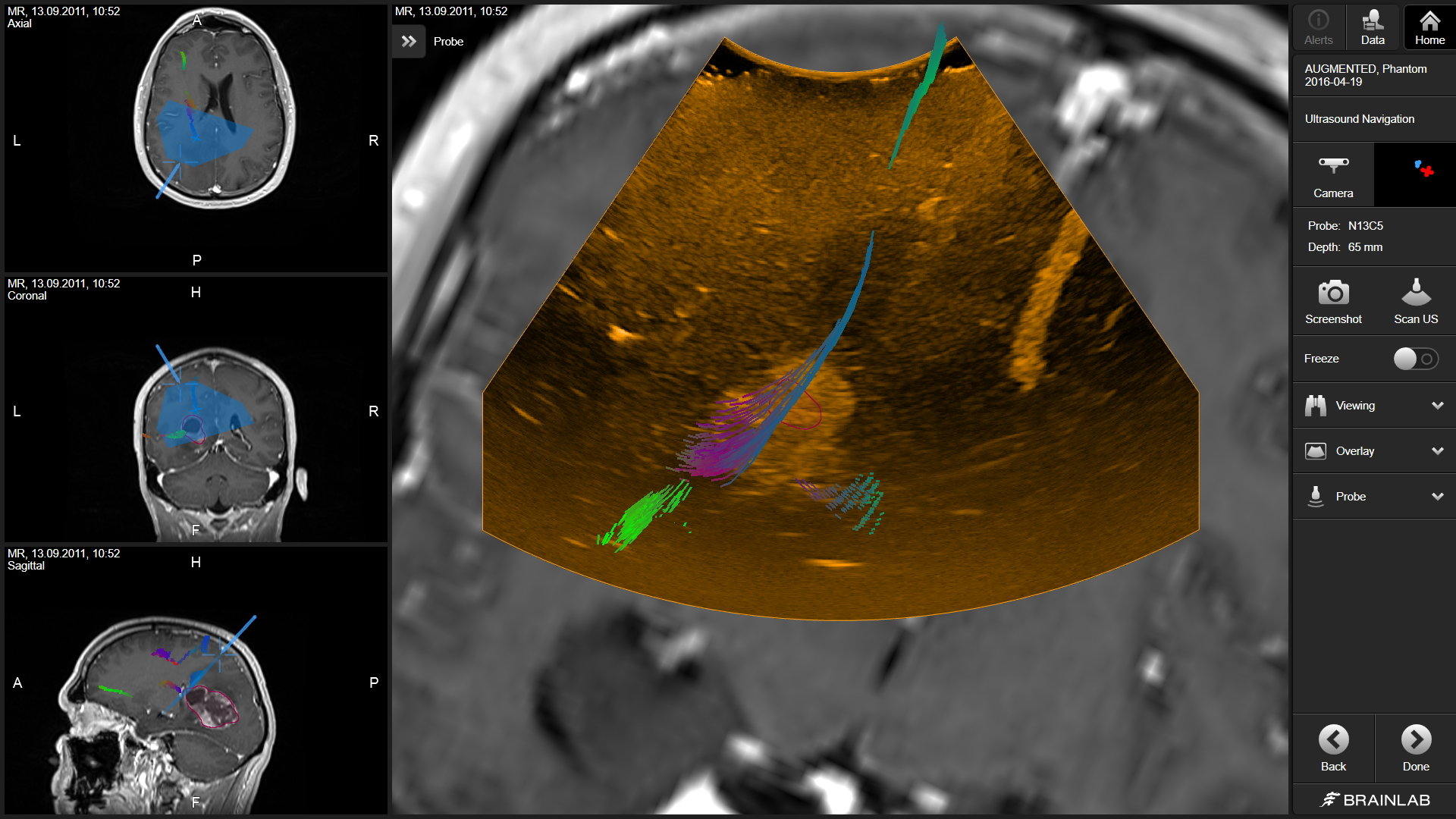 Ultrasound Navigation Software Screenshot: 2D Ultrasound image overlaid on MR image with fibers