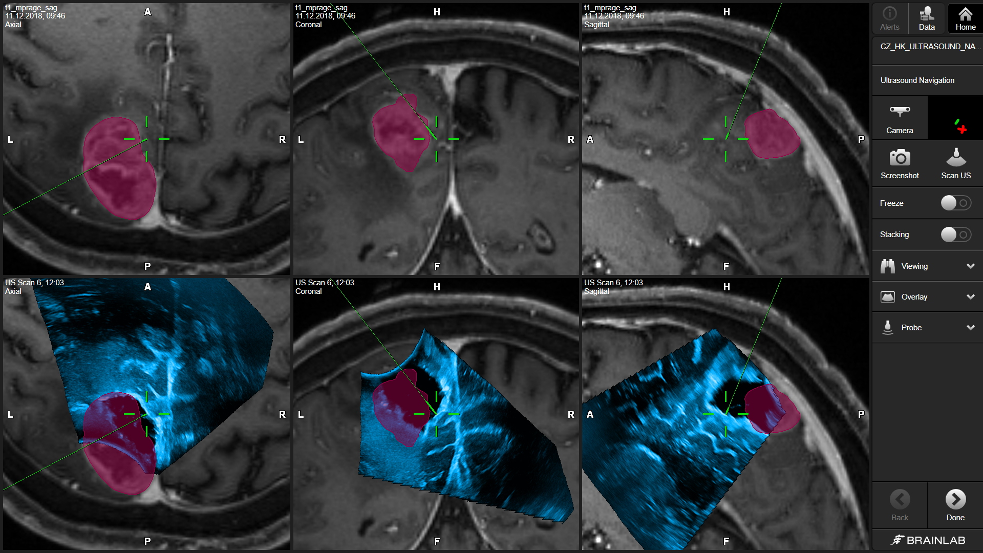 Ultrasound Navigation Software Screenshot: Preplanned tumor outline on MR image with 3D ultrasound scan in Navigation view