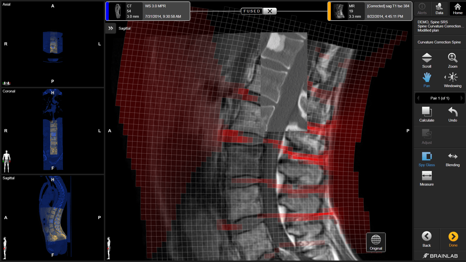 Screenshot: Elements Spine Curvature Correction - Compensating for spine curvature variations