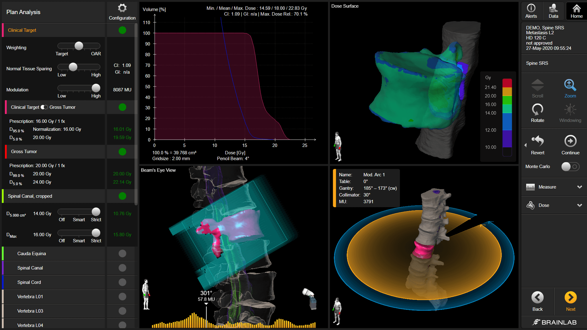 Screenshot: Elements Spine SRS - 3D Dose Evaluation for Spine Metastases