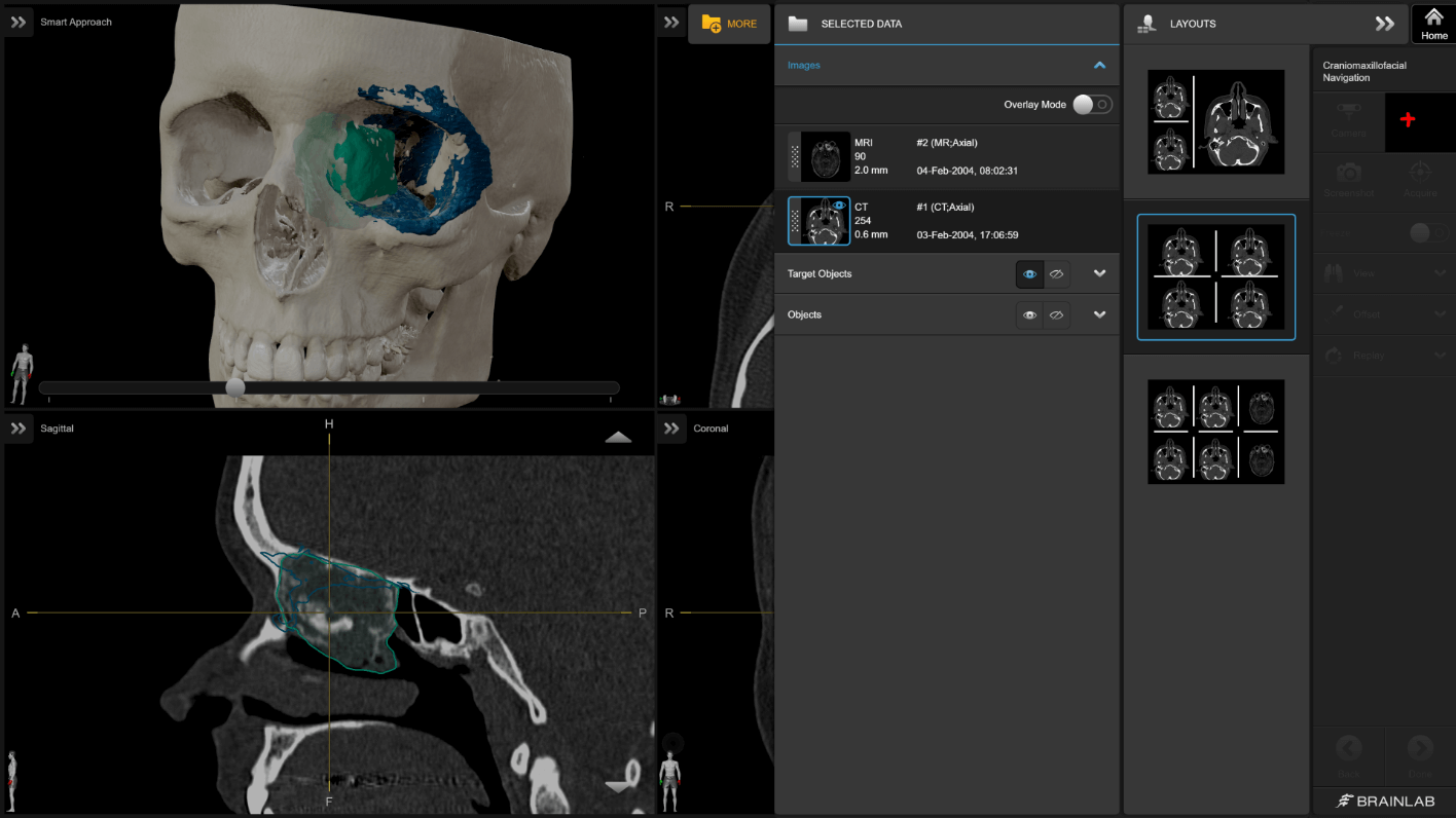 Screenshot: Brainlab Craniomaxillofacial (CMF) Navigation - Individually configured views