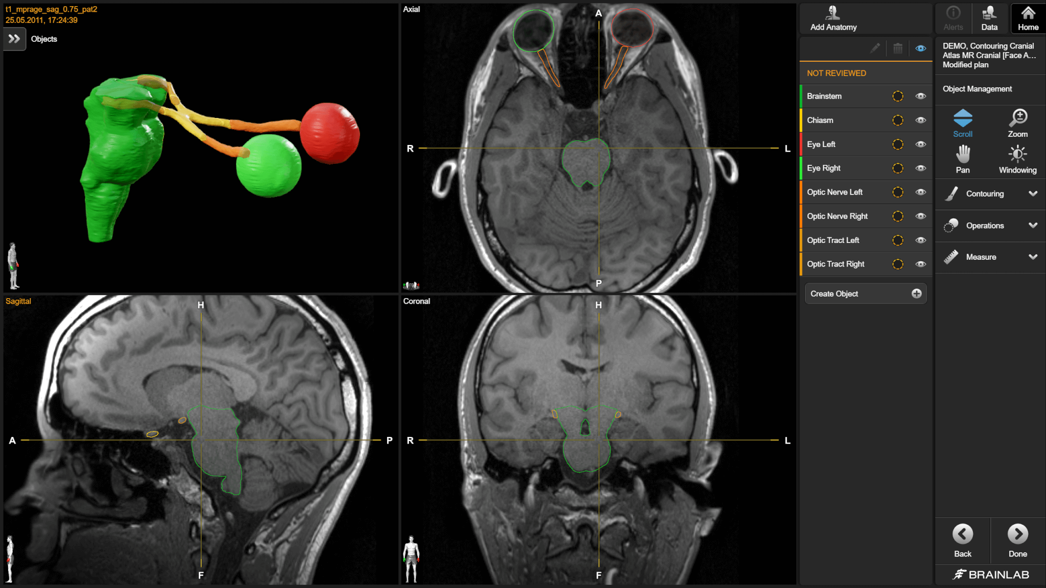 Screenshot of Elements Anatomical Mapping: organ-at-risk segmentation