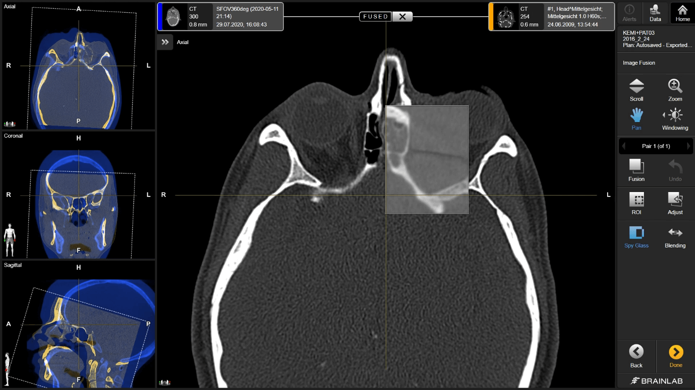 Screenshot: Intraoperative Results Control with CMF Navigation and Loop-X Mobile Imaging Robot